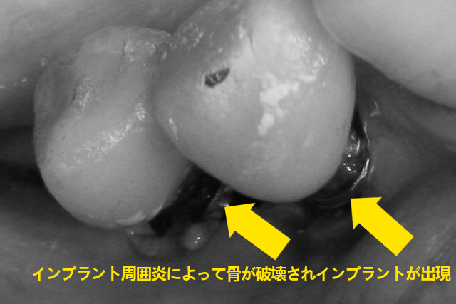 インプラント周囲炎